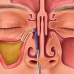 Balloon Sinuplasty