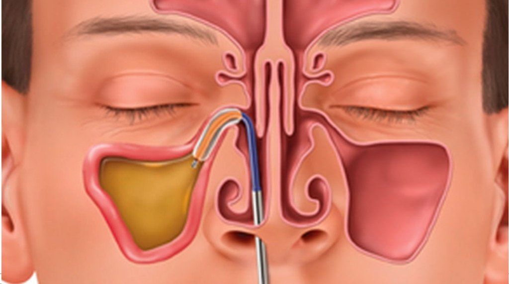 How Does Balloon Sinuplasty Open Sinus Passages? Balloon Sinuplasty